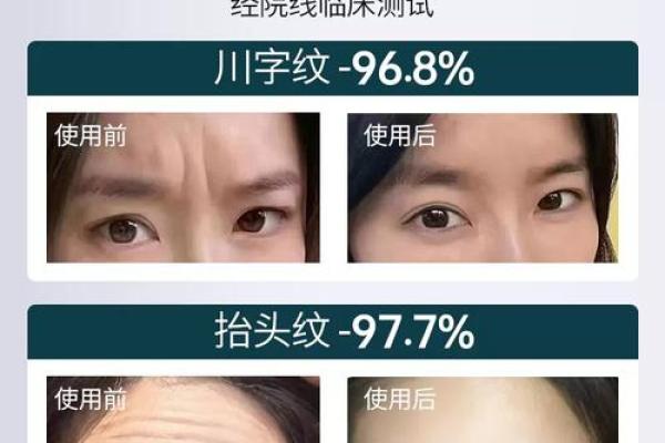 眉间八字纹消除