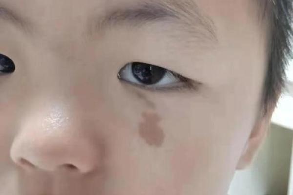脸上胎记算命图解