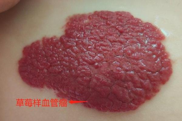 红色的胎记算命